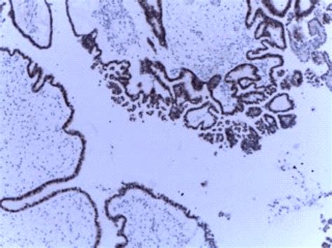 Borderline Ovarian Serous Tumor Er Positive In About 85 Of Tumor Cells