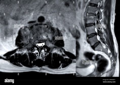 MRI L-S spine or lumbar spine Axial and sagittal T2 technique with ...