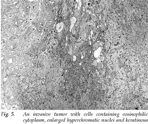 Figure 1 From Primary Squamous Cell Carcinoma Of The Breast A Case