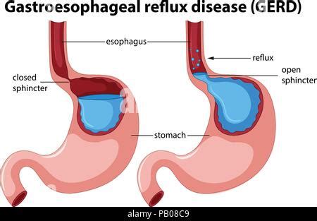 Diagram Of Gastroesophageal Reflux Disease Illustration Stock Vector