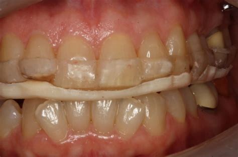 Converting Anterior Bite Plane to Full Arch Splint - Spear Education