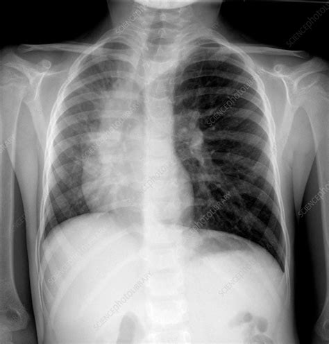 Collapsed Lung In Asthma X Ray Stock Image C0373055 Science