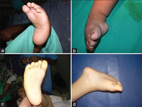 Clinical Photographs Showing A Plantar And B Lateral View Of The