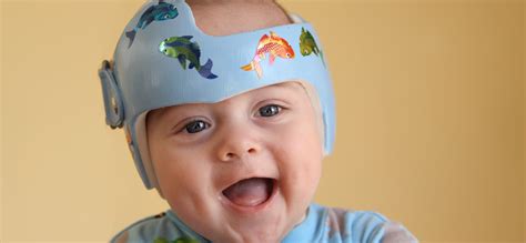 Craniosynostosis Surgery In Iran Medpersia Medical Tourism