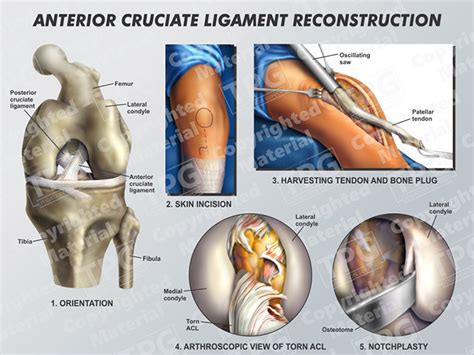 Anterior Cruciate Ligament Reconstruction 1