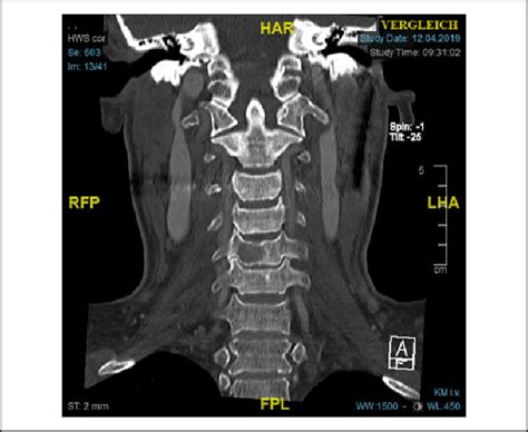 Coronal CT scan of the cervical spine shows an osteolytic lesion of C5. | Download Scientific ...