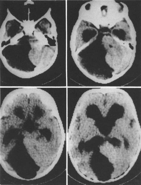 Retrocerebellar Arachnoid Cyst