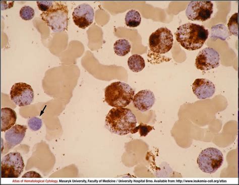 Chronic Myeloid Leukaemia CML BCR ABL1 Positive Blast Phase