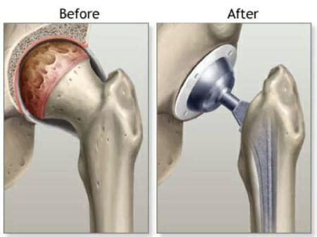 Anterior Approach Total Hip Replacement (AA-THR) - St. George Surgical ...