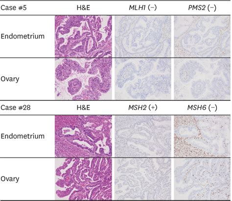 Mismatch Repair Protein Expression In Synchronous Endometrial And