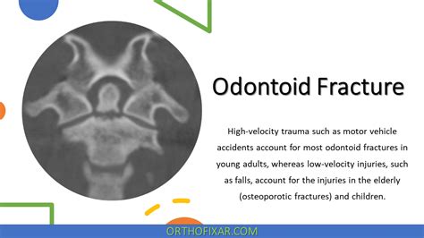 Odontoid Fracture Orthofixar