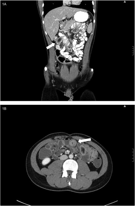 A Computed Tomography Ct Scan Of The Abdomen And Pelvis Depicting