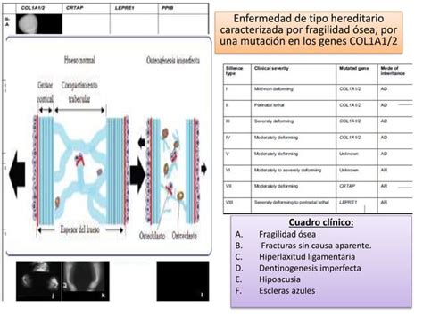 OSTEOGENESIS IMPERFECTA PPT