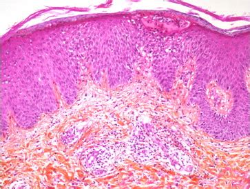 Intravenous Immunoglobulins Induced Eczematous Eruption A Long Term