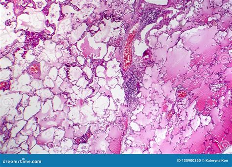 Lung Adenocarcinoma Stock Photo Image Of Cell Tissue 130900350