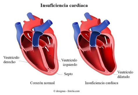 Insuficiencia Card Aca Clasificaci N Causas Y S Ntomas