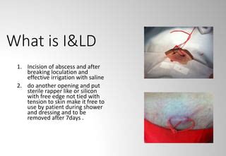 Loop drainage of Abscess | PPT