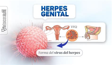 Herpes Genital S Ntomas Tratamiento Y Prevenci N