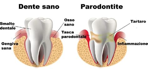 La Malattia Parodontale Come Prevenirla Studio Dentistico Dr