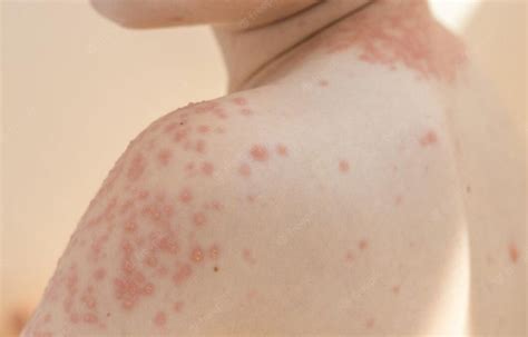 What Is Hives On Skin Symptoms Causes Treatment