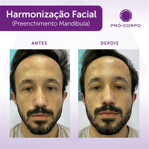 Harmoniza O Facial Harmoniza E Rejuvenesce O Seu Rosto Pr Corpo