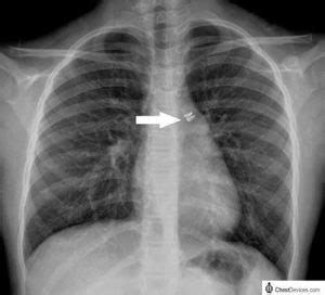 PATENT DUCTUS ARTERIOSUS (PDA) – radiologi.id