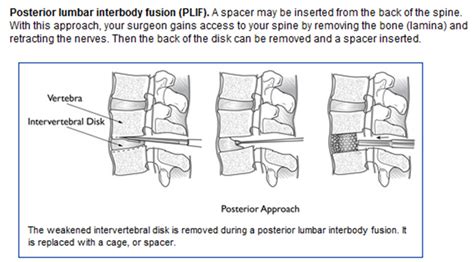 Lumbar Spinal Fusion Tlif Plif