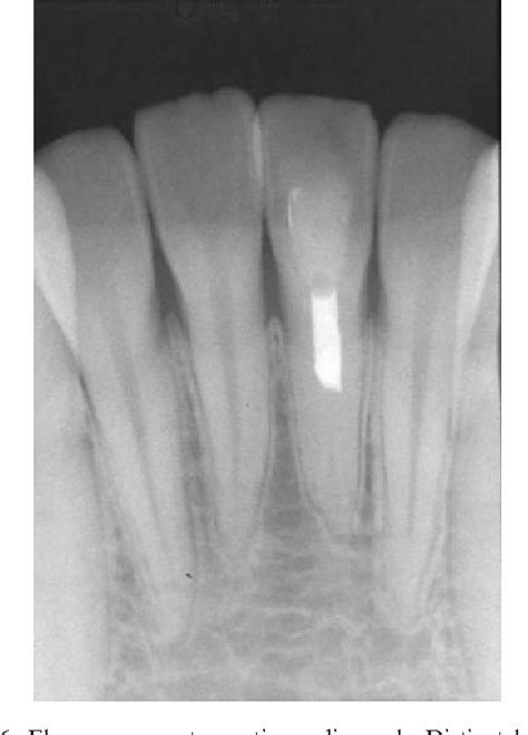 Figure From Revascularization Of An Immature Permanent Tooth With