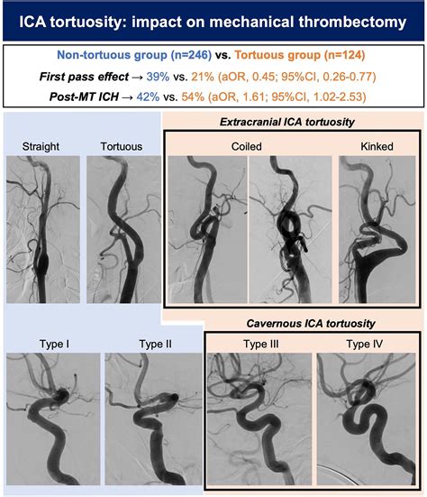 Best 13 Internal Carotid Artery and Its Aneurysms – Artofit