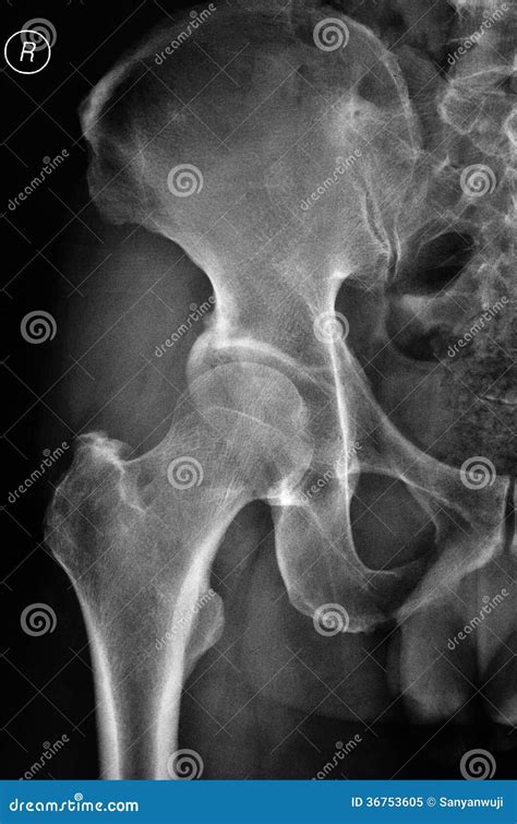 Right Hip X Ray Pictures Royalty Free Stock Photo Image 36753605