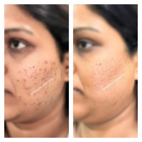 hyperpigmentation treatment  mumbai dark patches removal