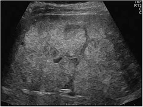 Abdomen And Retroperitoneum 1 1 Liver Case 1 1 9 Metastases