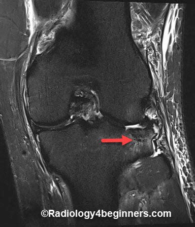 SegondFracture Radiology - ACL injury | Radiology For Beginners