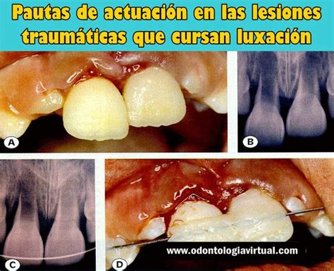 Traumatismo Dental Pautas De Actuaci N En Las Lesiones Traum Ticas Que