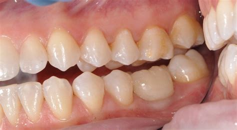 Emergence Profile For Implant Restorations Cad