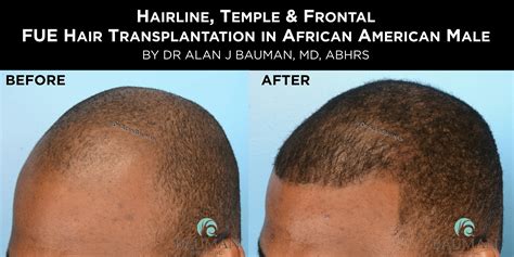 Hair Transplant Scar Black Men