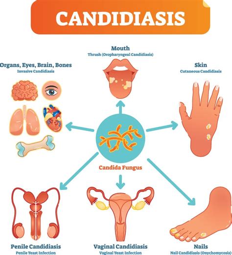 Penile Yeast Infection Symptoms In Men