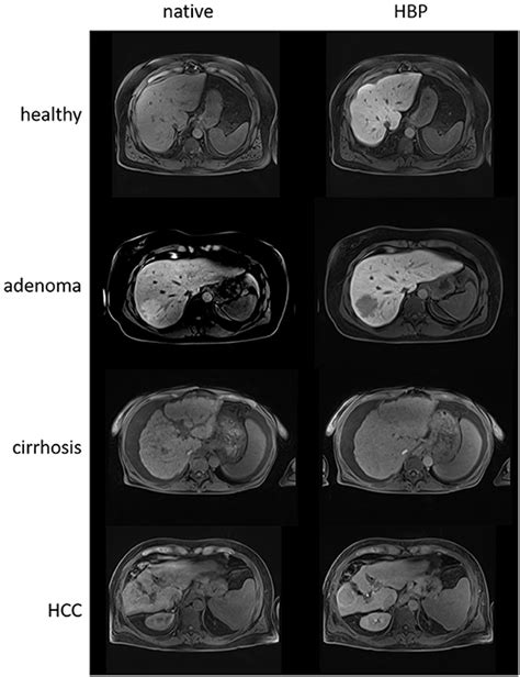 Fatty Liver Mri