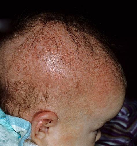 Skin Disease Types Seborrheic Dermatitis