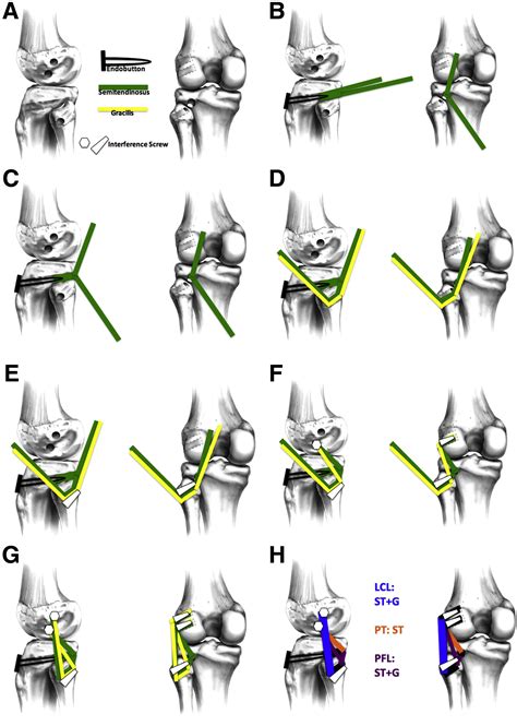 Anatomic Posterolateral Corner Reconstruction With Autografts