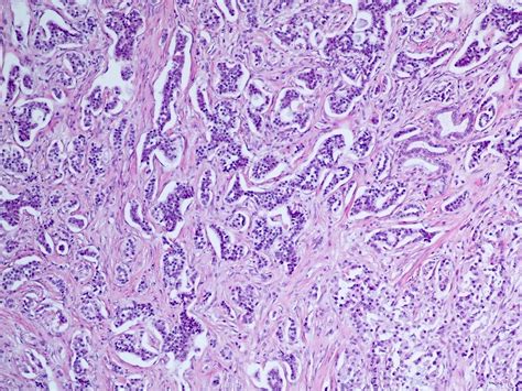 Pathology Outlines Neuroendocrine Neoplasms General