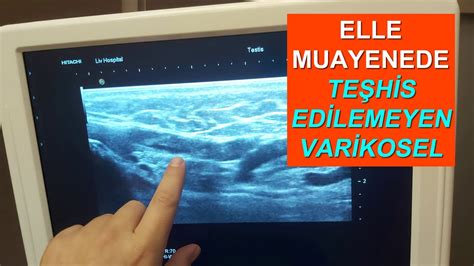 Subklinik Varikoselin Doppler Ultrason ile Teşhisi Elle Muayenede