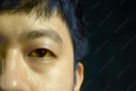 Deep Jaundice In Asian Male Patient Yellowish Discoloration Of Skin