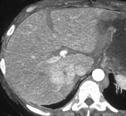 Multiple Masses Proven Focal Nodular Hyperplasia FNH In Rt Lobe