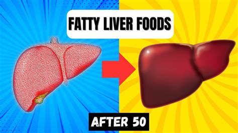 Strictly Avoid These 5 Foods If You Have Fatty Liver Fatty Liver