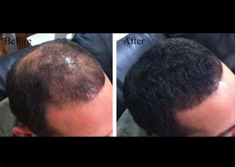 Onion Juice for Hair Growth, How to Use, Reviews, Before and After ...