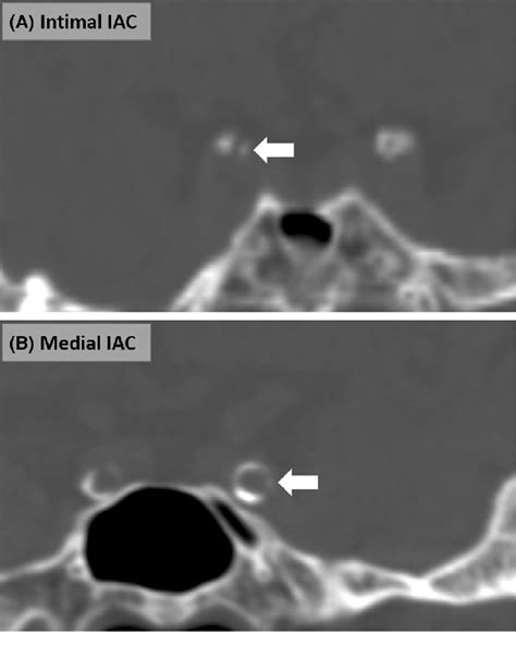 Patterns Of Intracranial Arterial Calcification Iac Intimal Iac A