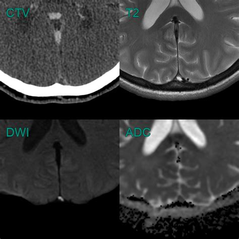 Dural Venous Sinus Thrombosis Neuroradiology