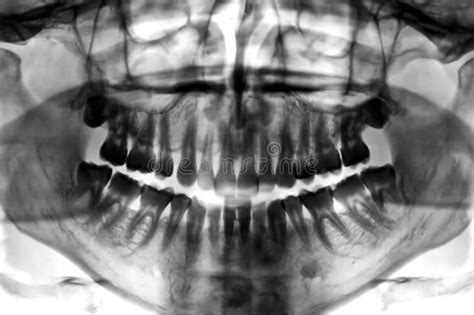 Dental Scan Types Of Fixed Appliances Stock Image Image Of Bite