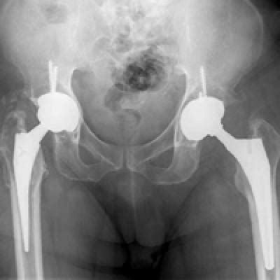 Acute Intraprosthetic Dissociation Of A Dual Mobility Hip In The United